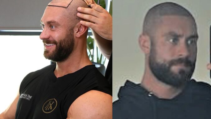 hair transplant in bodybuilding